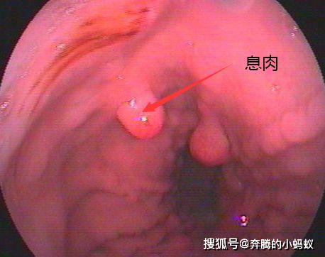 肾移植可以吃西湖瓜吗,西湖瓜的适宜性分析